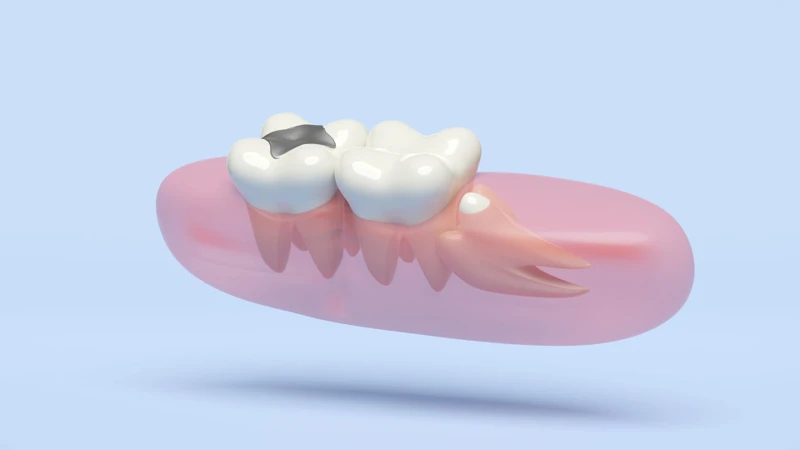 Răng khôn mọc lệch có thể gây nhiều biến chứng nguy hiểm