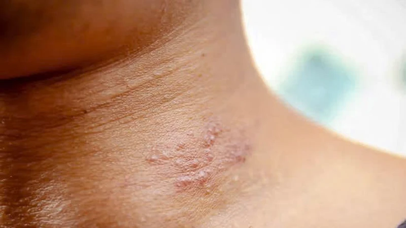 Nguyên nhân bị giời leo ở cổ và cách xử lý hiệu quả 1