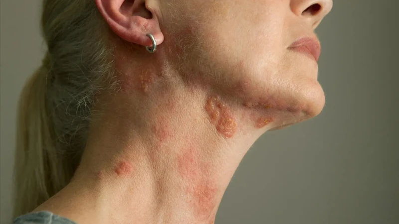 Nguyên nhân bị giời leo ở cổ và cách xử lý hiệu quả 4