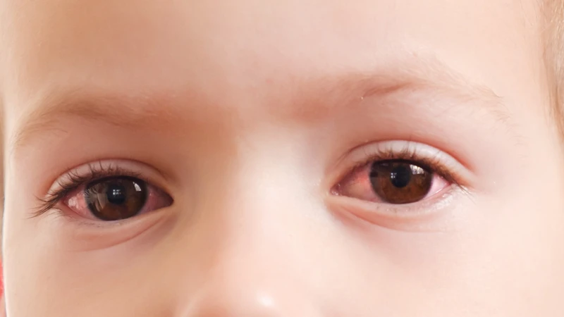 Nguyên nhân gây đau mắt đỏ ở trẻ và cách chăm sóc cha mẹ cần biết 1