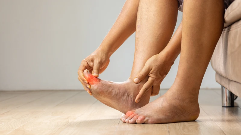 Gout là nguyên nhân phổ biến gây đau ngón chân cái