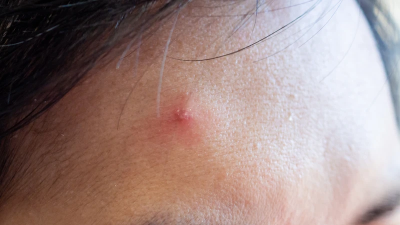 Nguyên nhân gây mụn bọc không đầu​ và cách điều trị chúng 3