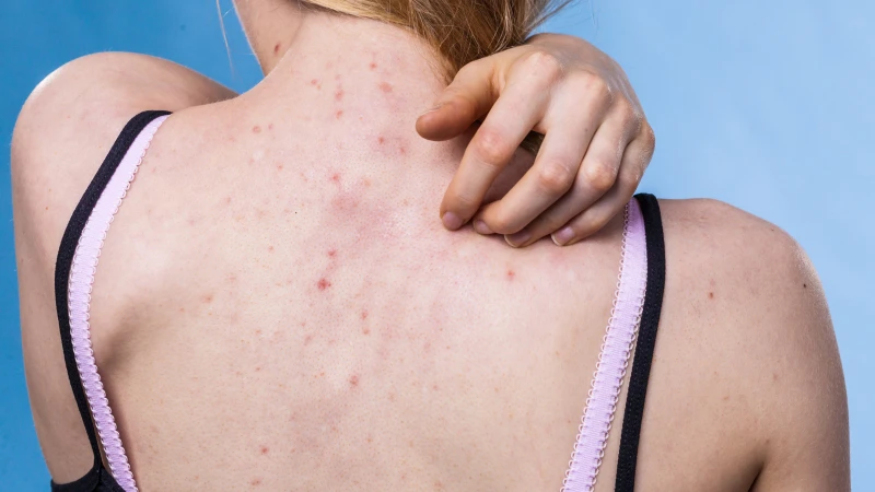 Căng thẳng kéo dài làm tăng cortisol, kích thích bã nhờn và tạo điều kiện khiến mụn lưng phát triển