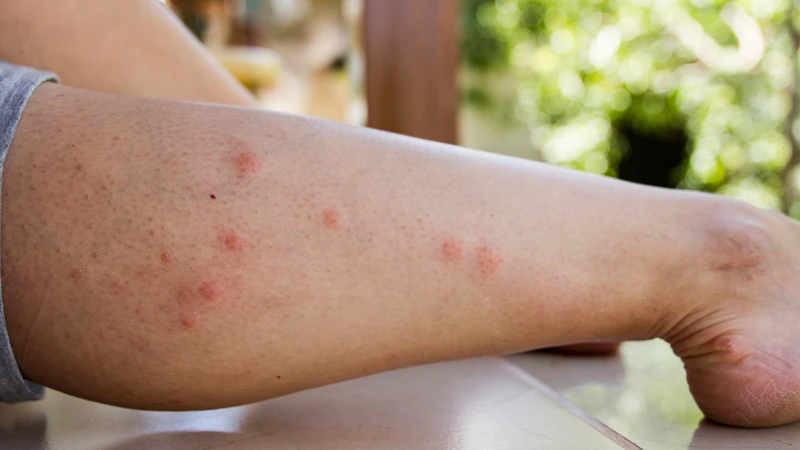 Nguyên nhân gây viêm nang lông ở chân là gì? Cách điều trị hiệu quả 2