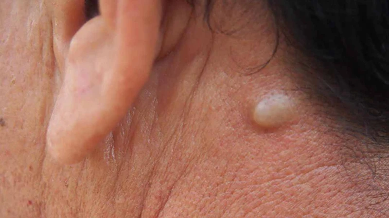 Nguyên nhân, mức độ nguy hiểm và biến chứng của lao hạch 2