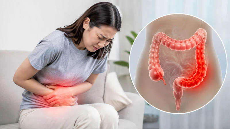 Viêm đại tràng kéo dài làm tăng nguy cơ loạn sản và ung thư đại trực tràng