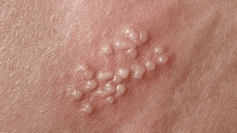Nguyên nhân nổi mụn ở mép vùng kín nữ và cách phòng ngừa 2