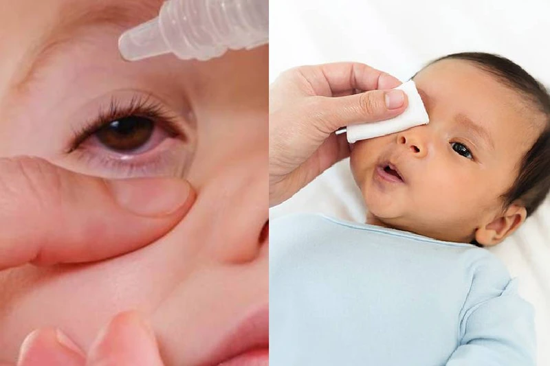 Nguyên nhân trẻ sơ sinh bị đau mắt và cách chăm sóc giúp bé nhanh khỏi 3