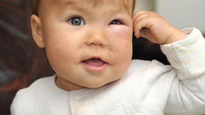 Nguyên nhân và cách xử lý khi trẻ bị sưng mắt khi ngủ dậy ba mẹ cần biết 1