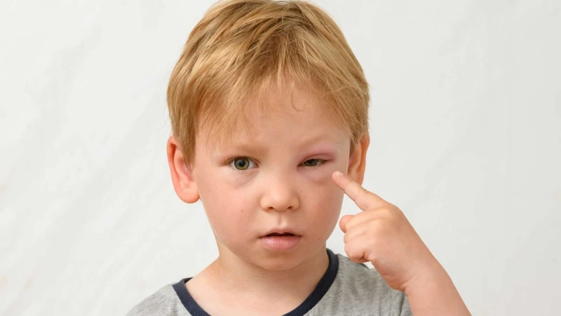 Nhận biết hình ảnh bệnh sốt xuất huyết ở trẻ em qua từng giai đoạn 7