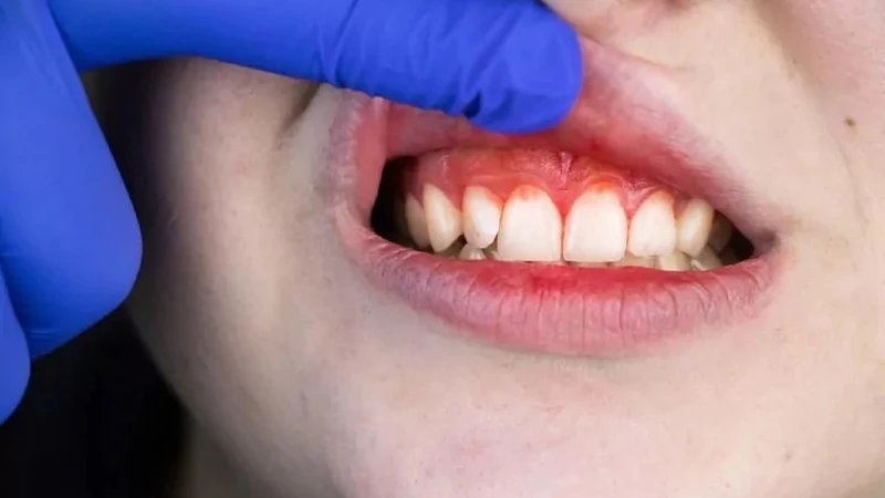 Nhận biết hình ảnh bệnh sốt xuất huyết ở trẻ em qua từng giai đoạn 6