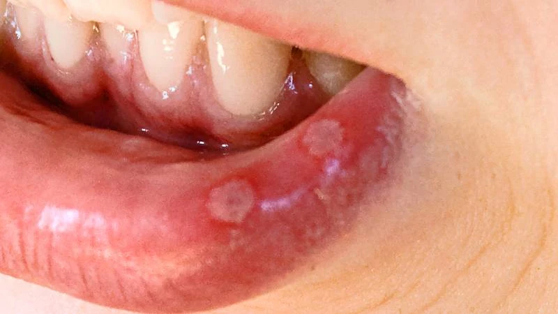 Nhận biết hình ảnh nhiệt miệng qua từng giai đoạn và thời điểm cần đi khám 3