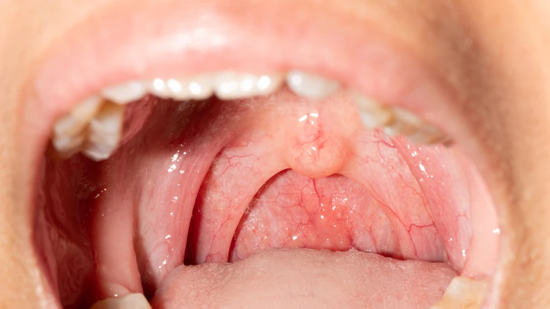 Nhận biết hình ảnh viêm họng mủ ở trẻ em 2