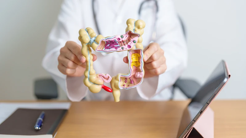 Polyp đại tràng dễ bị nhầm lẫn với các bệnh lý tiêu hóa