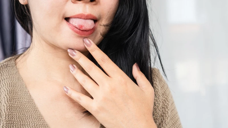 Nhiệt lưỡi gây ra cảm giác đau rát và khó chịu
