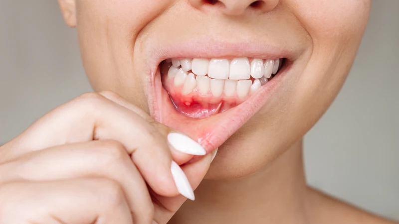Nếu vết loét nhỏ, đau vừa phải và bạn vẫn ăn uống được