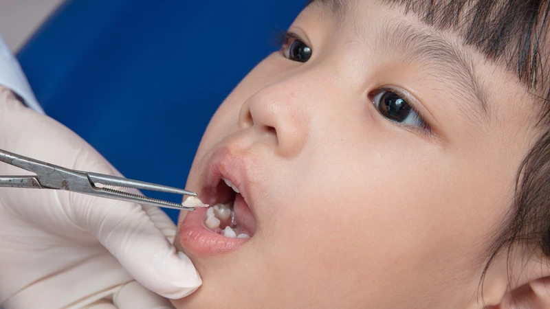 Đưa trẻ đến nha sĩ là giải pháp an toàn nhất để thay răng sữa