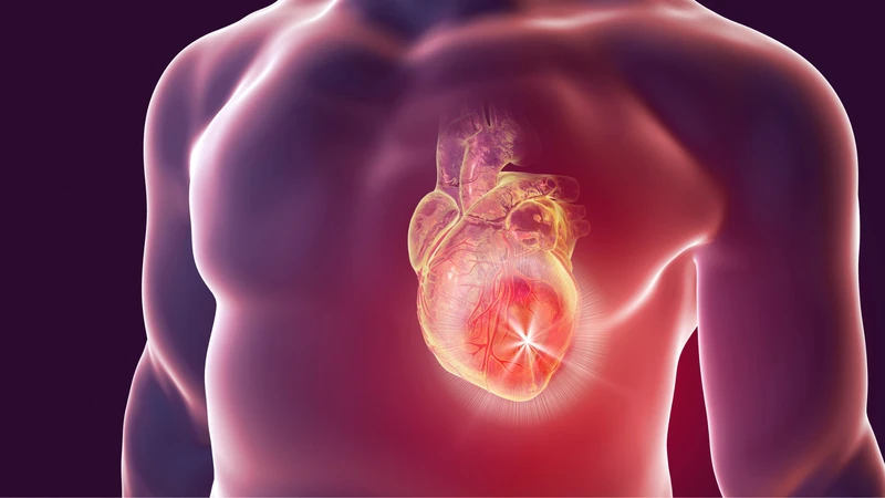 Nhồi máu cơ tim type 2: Nguyên nhân, triệu chứng và cách phòng ngừa 1