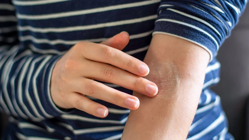 Đối với các trường hợp hắc lào nhẹ, cách điều trị hắc lào hiệu quả bằng thuốc bôi chống nấm được bác sĩ chỉ định