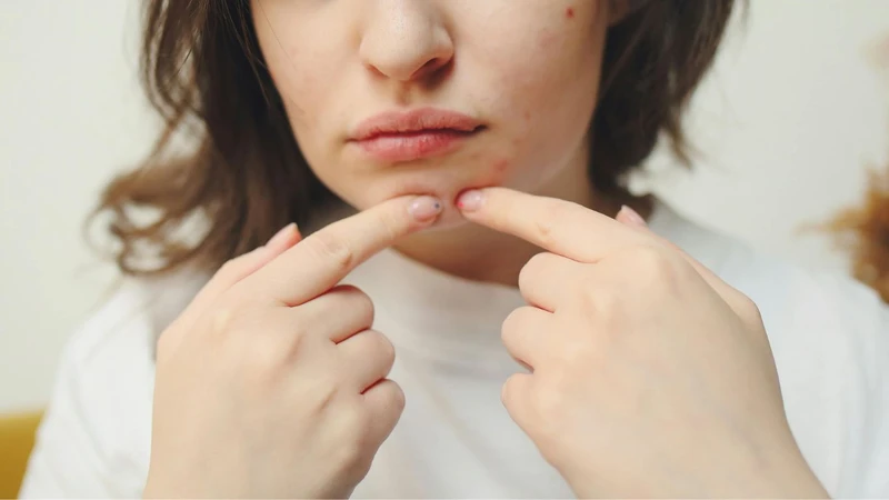 Những cách trị mụn nội tiết ở cằm​ đơn giản, dễ thực hiện 3