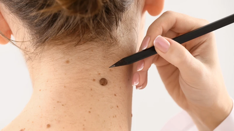 Những dấu hiệu ung thư da và phương pháp phòng ngừa hiệu quả 2