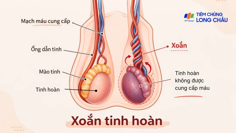 Đau bìu dữ dội là một trong những dấu hiệu xoắn tinh hoàn