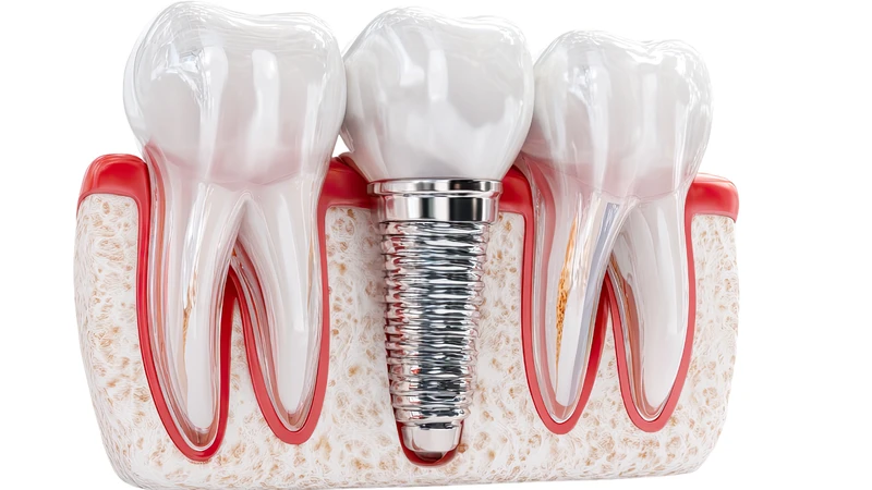 Tuổi thọ của răng Implant phụ thuộc vào chất lượng của trụ