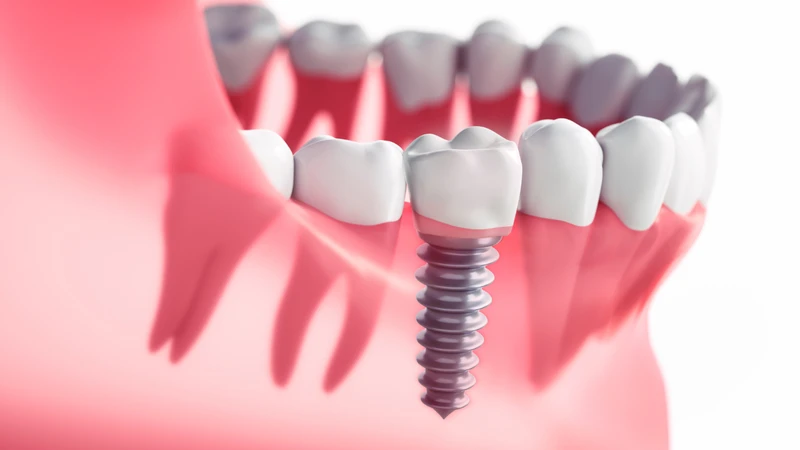 Quá trình điều trị trồng răng implant thường kéo dài nhiều tháng