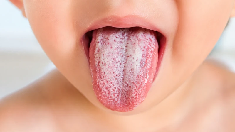 Nấm miệng là bệnh lý do nấm Candida phát triển quá mức trong khoang miệng