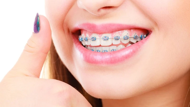niềng răng bao nhiêu tiền 2 hàm