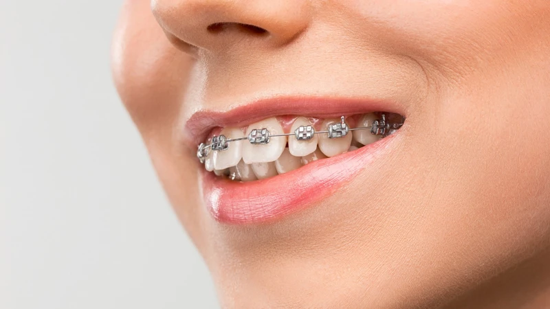 Răng lệch lạc càng nhiều thì chi phí niềng răng 2 hàm thường càng cao do mức độ điều trị phức tạp hơn