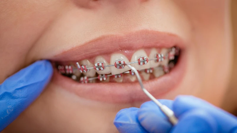 Chi phí niềng răng 2 hàm cũng phụ thuộc nhiều vào tay nghề bác sĩ và hệ thống nha khoa thực hiện
