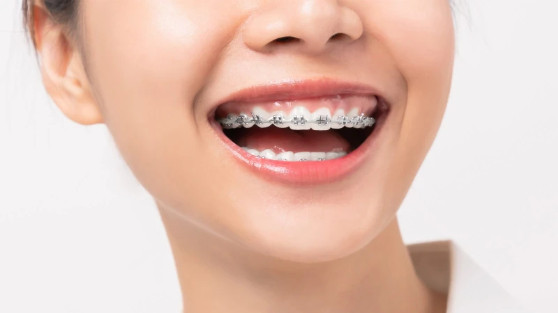 Lựa chọn phương pháp niềng phù hợp cũng là cách giúp tối ưu và tiết kiệm chi phí điều trị
