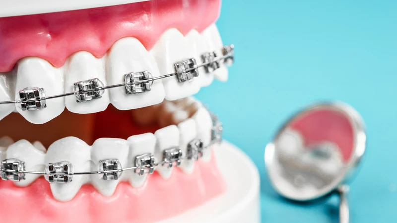 Niềng răng mắc cài kim loại sử dụng hệ thống mắc cài và dây cung để tạo lực