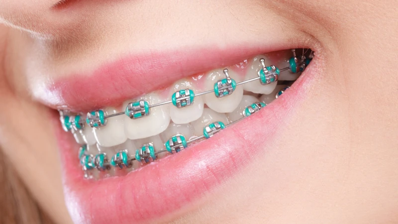 Niềng răng thưa sử dụng khí cụ chỉnh nha để dịch chuyển các răng