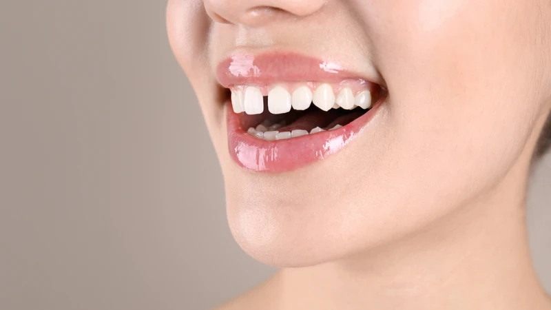 Răng thưa là tình trạng giữa hai hoặc nhiều răng xuất hiện khoảng cách