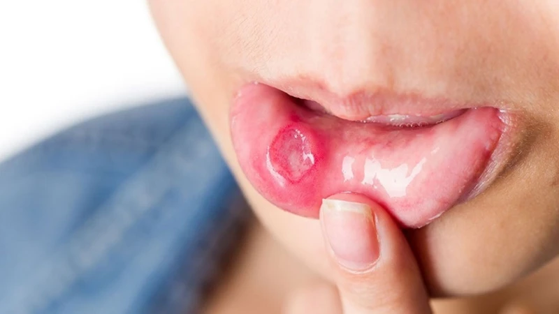 Nổi đẹn trong miệng là tình trạng mà ai trong chúng ta đều có thể gặp phải