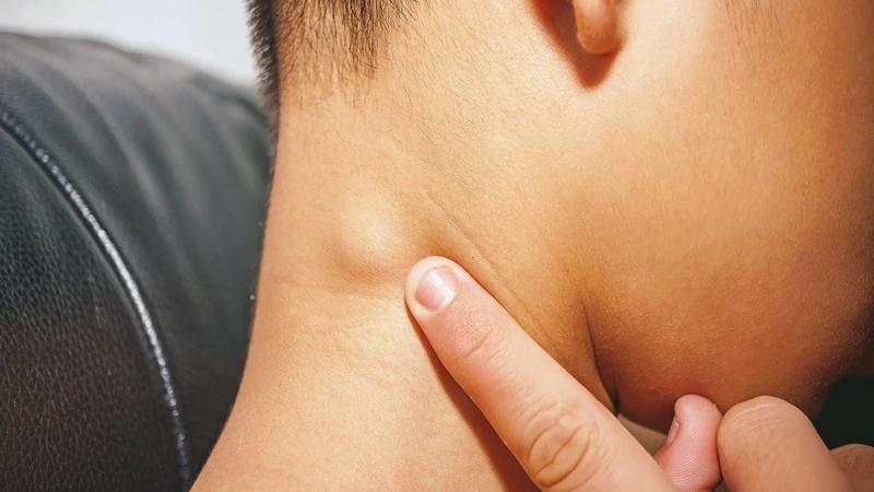 Nổi hạch ở cổ lâu ngày không đau 1