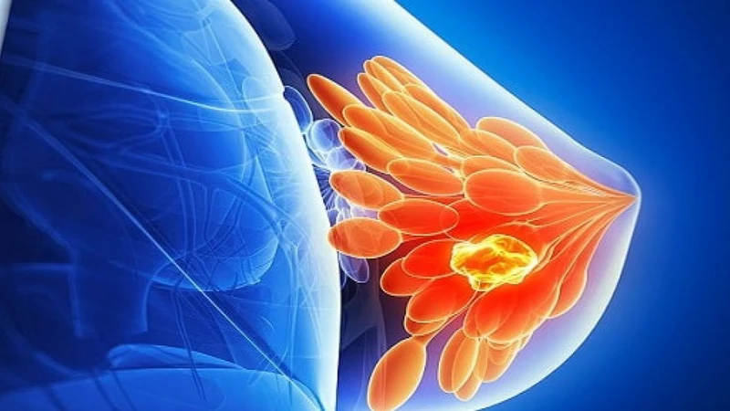 Nổi hạch ở nách là gì? Nguyên nhân, triệu chứng và cách điều trị hiệu quả 2.png