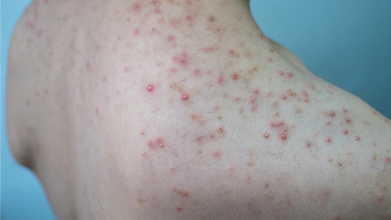 Nổi hạch ở nách là gì? Nguyên nhân, triệu chứng và cách điều trị hiệu quả 3.png