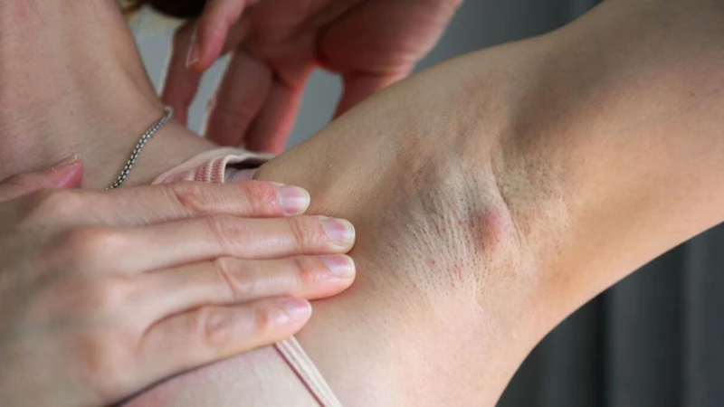 Nhiễm trùng da hoặc viêm nang lông có thể kích thích hệ miễn dịch, khiến hạch bạch huyết phản ứng và sưng lên