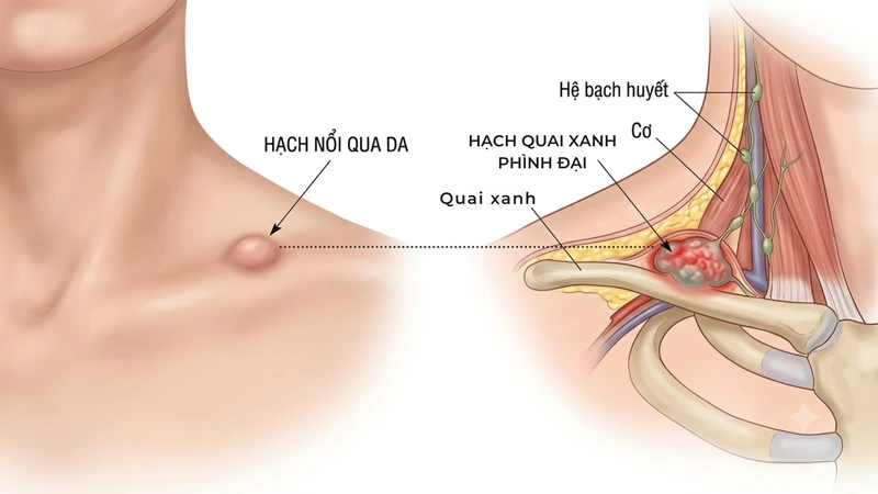 Nổi hạch ở xương quai xanh có thể xuất hiện ở một hoặc cả hai bên
