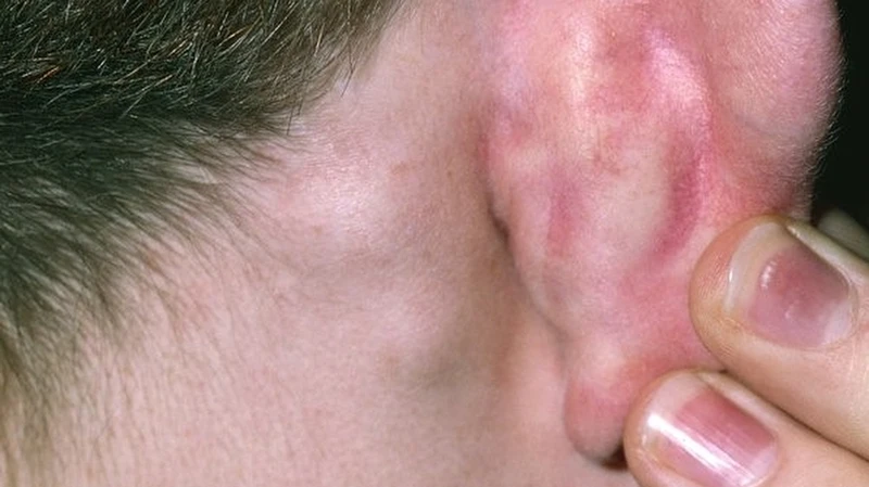 Nổi hạch sau đầu ở trẻ em là gì? Nguyên nhân và cách điều trị 1