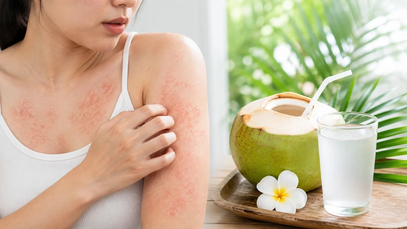 Nổi mề đay uống nước dừa được không phụ thuộc khả năng dung nạp