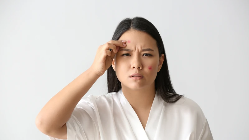 Nổi mụn nhọt liên tục: Dấu hiệu cảnh báo sức khỏe bạn không nên bỏ qua 3