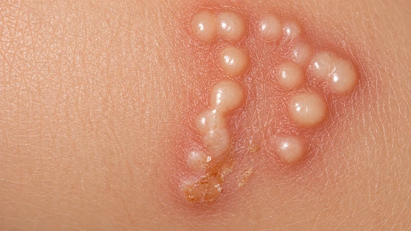 Mụn nước có thể xuất hiện do virus, kích ứng hoặc tổn thương da