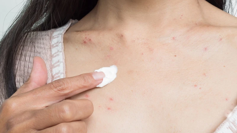 Chỉ dùng thuốc bôi chứa steroid hoặc kháng sinh khi có chỉ định của bác sĩ sau thăm khám