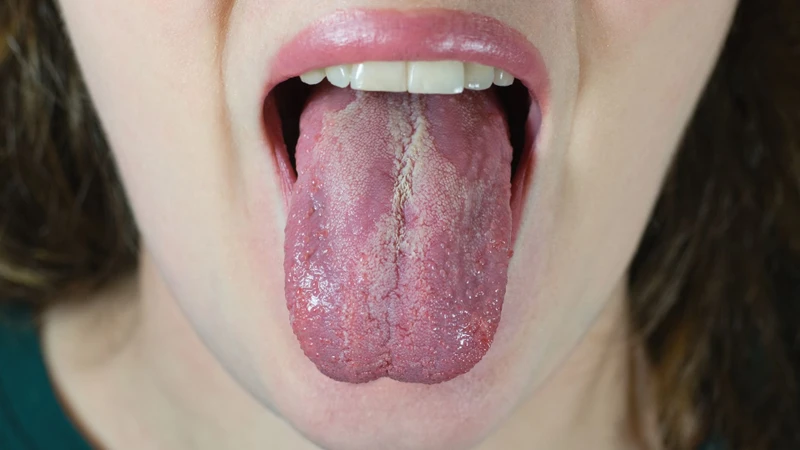 Nổi mụn ở lưỡi có thể là dấu hiệu của tình trạng nhiễm nấm quanh miệng