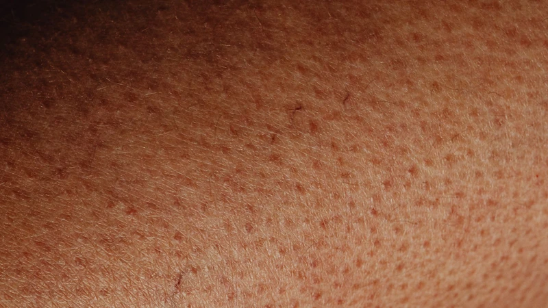 Bít tắc lỗ chân lông là một trong những nguyên nhân phổ biến gây nổi mụn ở vùng ngực