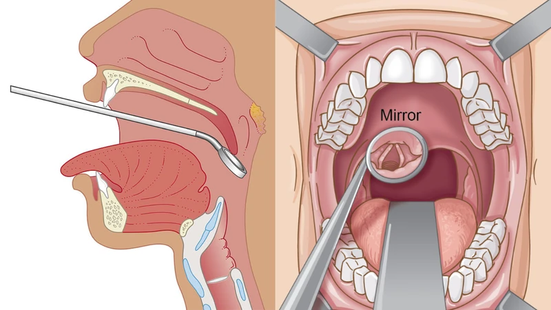 Nội soi thanh quản gián tiếp là thủ thuật an toàn, đơn giản, dễ thực hiện